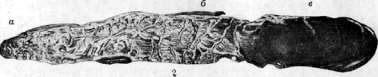Thrombus: figure 2 from the 1928–1936 encyclopedia article