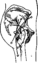 Arthrotomy: figure 3 from the 1928–1936 encyclopedia article
