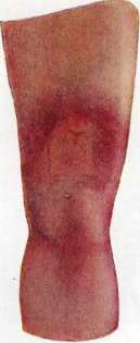 Dermatoses: figure 3 from the 1928–1936 encyclopedia article