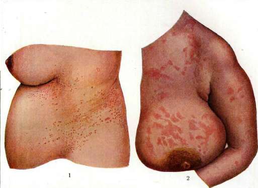 Dermatoses: figure 1 from the 1928–1936 encyclopedia article