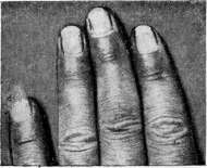 Onychia: figure 5 from the 1928–1936 encyclopedia article