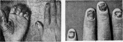 Onychia: figure 3 from the 1928–1936 encyclopedia article