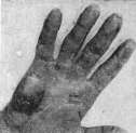 Onychia: figure 1 from the 1928–1936 encyclopedia article