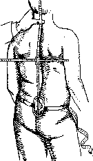 Scoliometer: figure 1 from the 1928–1936 encyclopedia article