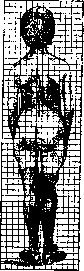 Scoliometer: figure 3 from the 1928–1936 encyclopedia article