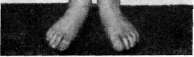 Eunuchoidism: figure 3 from the 1928–1936 encyclopedia article