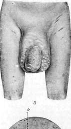 Eunuchoidism: figure 2 from the 1928–1936 encyclopedia article