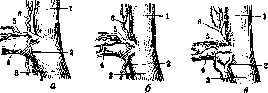 Stupor: figure 6 from the 1928–1936 encyclopedia article