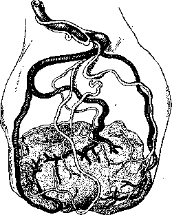 Insertio Velamentosa: figure 1 from the 1928–1936 encyclopedia article