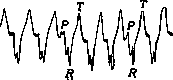 Electrocardiography: figure 15 from the 1928–1936 encyclopedia article