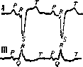 Electrocardiography: figure 18 from the 1928–1936 encyclopedia article