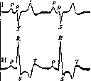 Electrocardiography: figure 9 from the 1928–1936 encyclopedia article