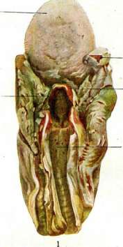 Diphtheritis: figure 7 from the 1928–1936 encyclopedia article