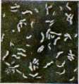 Diphtheritis: figure 11 from the 1928–1936 encyclopedia article