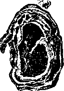 Pachymeningitis: figure 1 from the 1928–1936 encyclopedia article