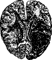 Apoplexy: figure 1 from the 1928–1936 encyclopedia article
