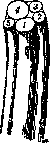 Stoffel Operation: figure 1 from the 1928–1936 encyclopedia article