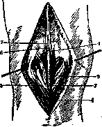 Stoffel Operation: figure 4 from the 1928–1936 encyclopedia article