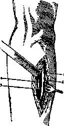 Stoffel Operation: figure 2 from the 1928–1936 encyclopedia article
