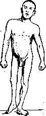 Flatfoot: figure 9 from the 1928–1936 encyclopedia article