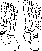 Flatfoot: figure 7 from the 1928–1936 encyclopedia article