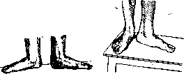 Flatfoot: figure 2 from the 1928–1936 encyclopedia article