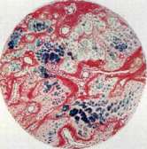 Cancer: figure 2 from the 1928–1936 encyclopedia article
