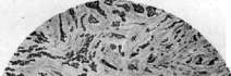 Cancer: figure 6 from the 1928–1936 encyclopedia article
