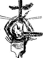 Prostate Gland: figure 20 from the 1928–1936 encyclopedia article