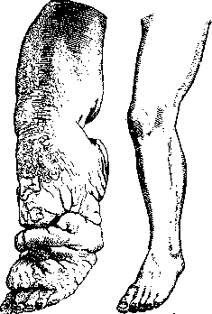 Elephantiasis: figure 1 from the 1928–1936 encyclopedia article