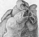 Inguinal Region: figure 3 from the 1928–1936 encyclopedia article