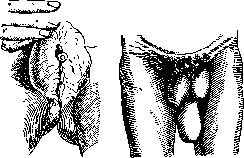 Scrotum: figure 4 from the 1928–1936 encyclopedia article