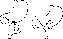 Gastroenterostomy: figure 5 from the 1928–1936 encyclopedia article