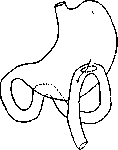 Gastroenterostomy: figure 1 from the 1928–1936 encyclopedia article