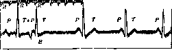 Extrapyramidal System: figure 2 from the 1928–1936 encyclopedia article
