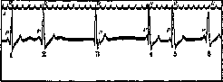 Extrapyramidal System: figure 6 from the 1928–1936 encyclopedia article