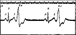 Extrapyramidal System: figure 5 from the 1928–1936 encyclopedia article