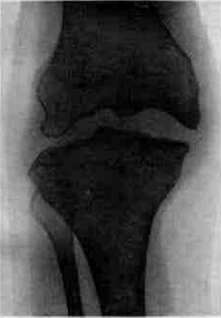 Gonitis: figure 3 from the 1928–1936 encyclopedia article