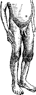 Gonitis: figure 2 from the 1928–1936 encyclopedia article