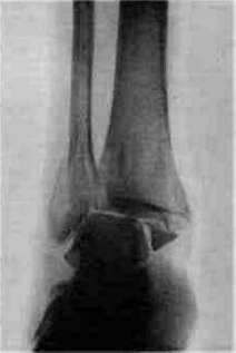 Gonitis: figure 4 from the 1928–1936 encyclopedia article