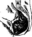 Caput Succedaneum: figure 1 from the 1928–1936 encyclopedia article