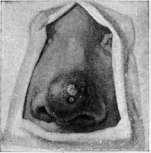 Tuberculous Skin Diseases: figure 4 from the 1928–1936 encyclopedia article