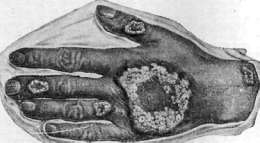 Tuberculous Skin Diseases: figure 5 from the 1928–1936 encyclopedia article