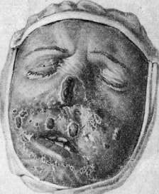 Tuberculous Skin Diseases: figure 3 from the 1928–1936 encyclopedia article