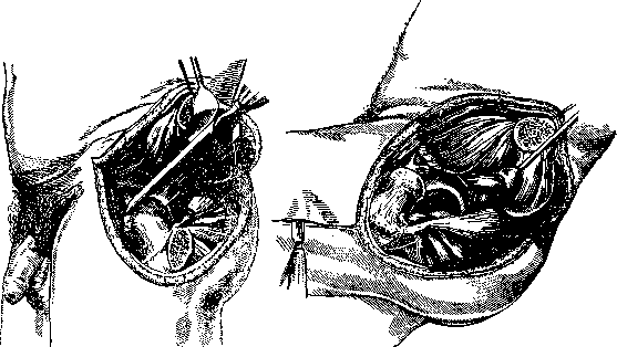 Hip Joint: figure 44 from the 1928–1936 encyclopedia article