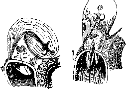 Trachelotomy: figure 4 from the 1928–1936 encyclopedia article