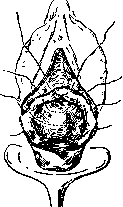 Vaginofixation: figure 3 from the 1928–1936 encyclopedia article