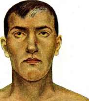 Jaundice: figure 1 from the 1928–1936 encyclopedia article