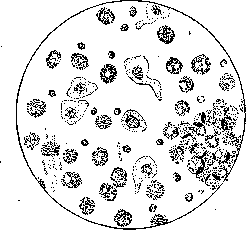 Pyuria: figure 1 from the 1928–1936 encyclopedia article