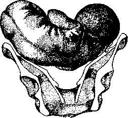 Fetal Position Anomalies: figure 3 from the 1928–1936 encyclopedia article